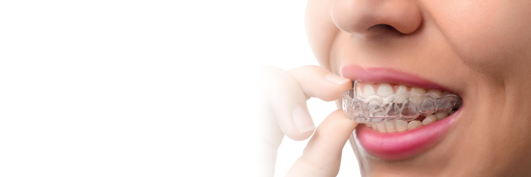 ClearCorrect Invisible Braces | Dentist