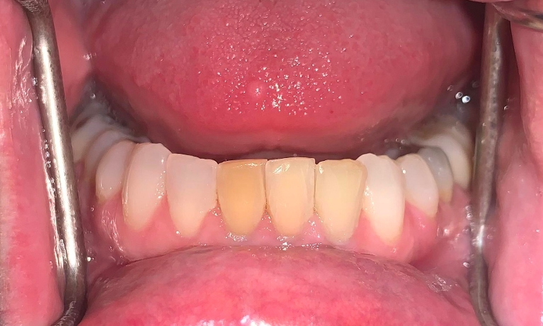 Internal-Bleaching-Before-Image